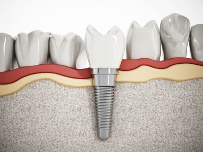 Signs That It&#   ;s Time To Replace Teeth Mini Implants