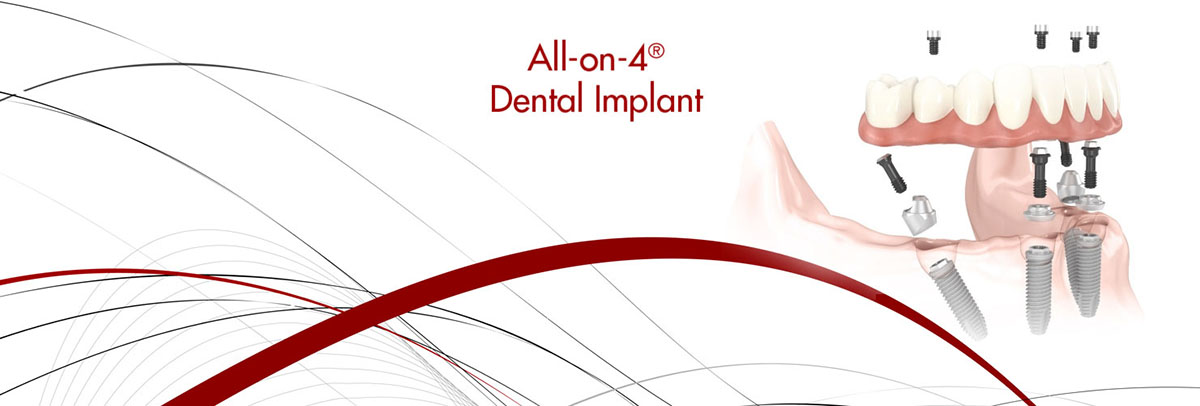 Carmel All-on-4 Dental Implants