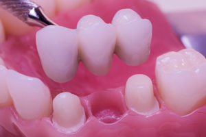 What Is A Dental Bridge Made Of?
