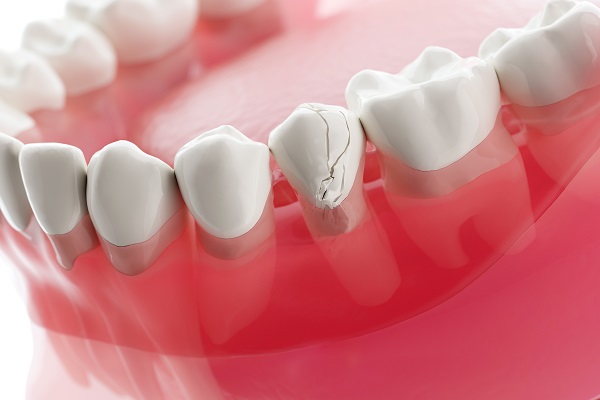 What To Do When You Have A Broken Tooth