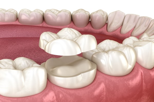 A Beginners Guide to Dental Crowns