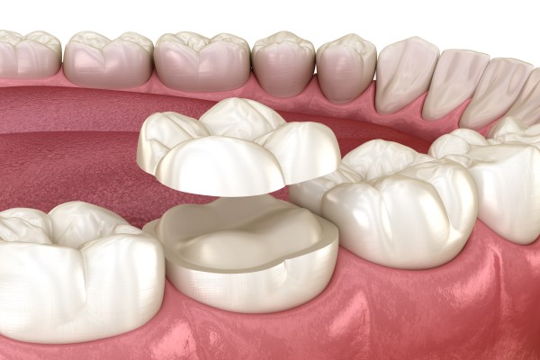 A Beginners Guide To Dental Crowns