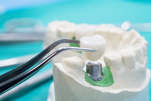 What Is A Dental Crown?