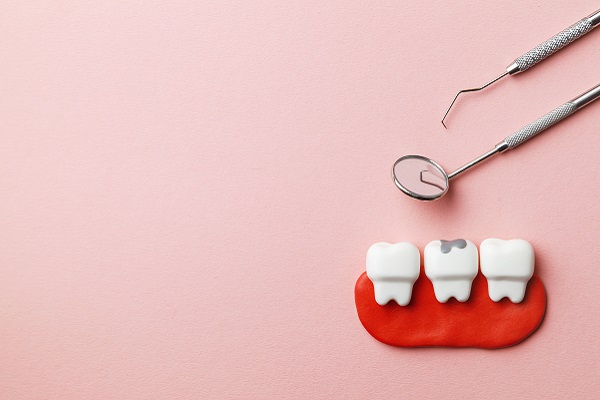 What To Expect When Getting Dental Fillings For Cavities