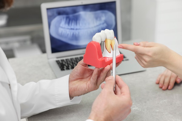 How Long Do Dental Implants Last?