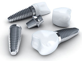 Carmel Am I a Candidate for Dental Implants
