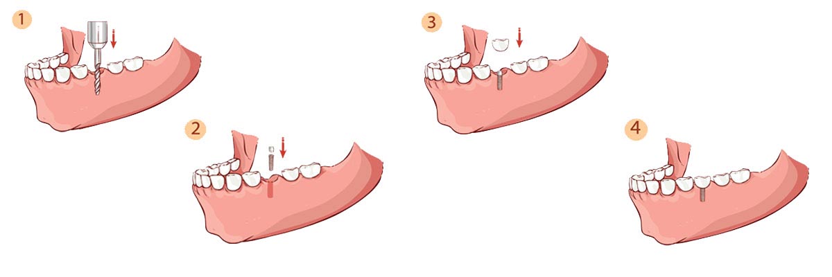 Carmel The Dental Implant Procedure