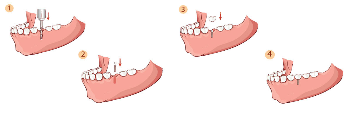 Carmel Dental Implant Restoration