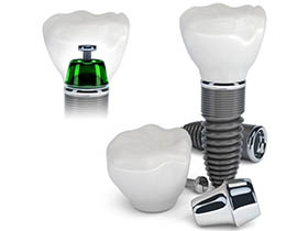 Carmel Dental Implant Surgery