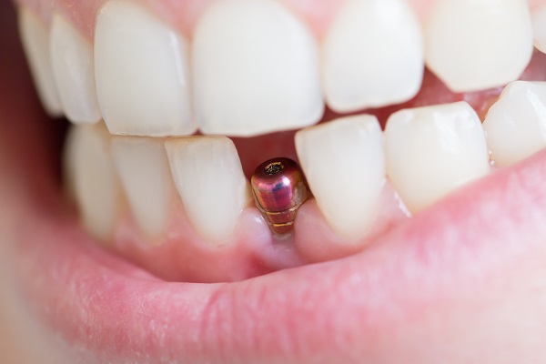 Dental Implants Carmel, IN