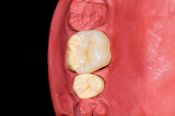 Dental Restorations Carmel, IN