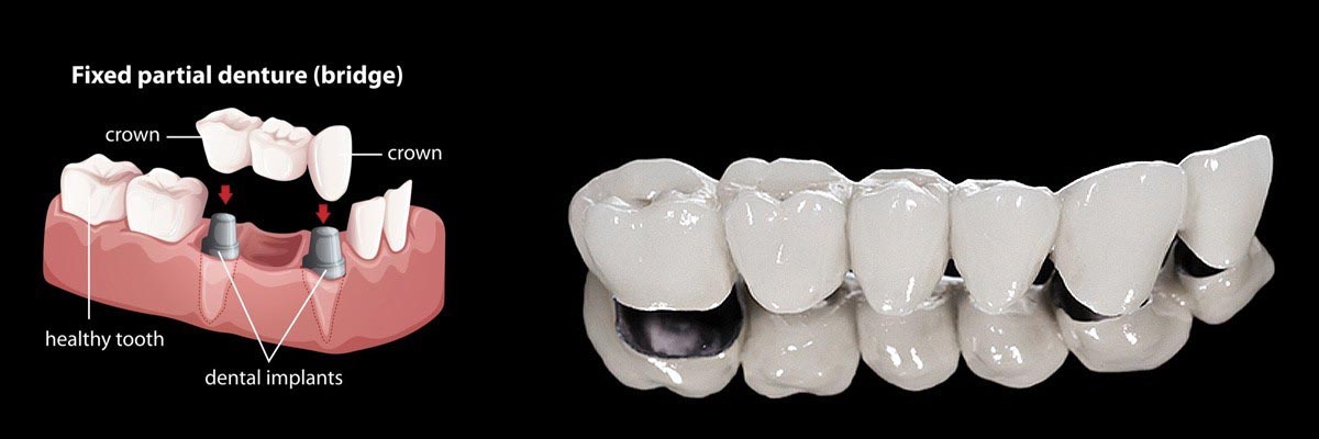 Carmel Dentures