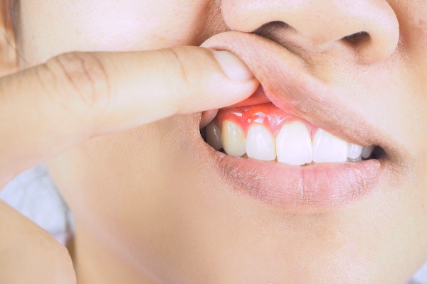 Is Gum Disease Preventable?