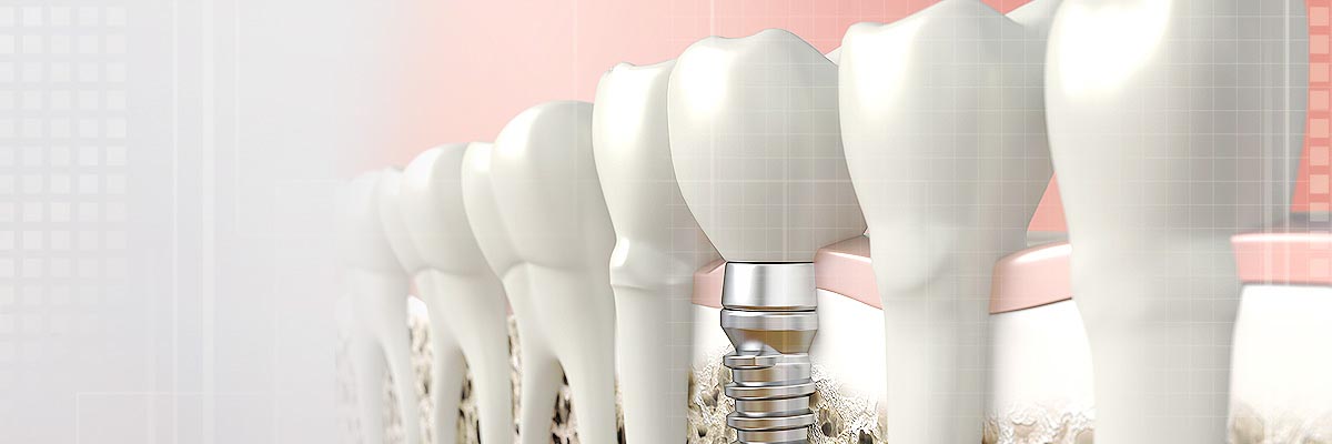 Carmel Implant Dentist