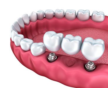 Learn How An Implant Dentist Can Replace Your Ill Fitting Dentures
