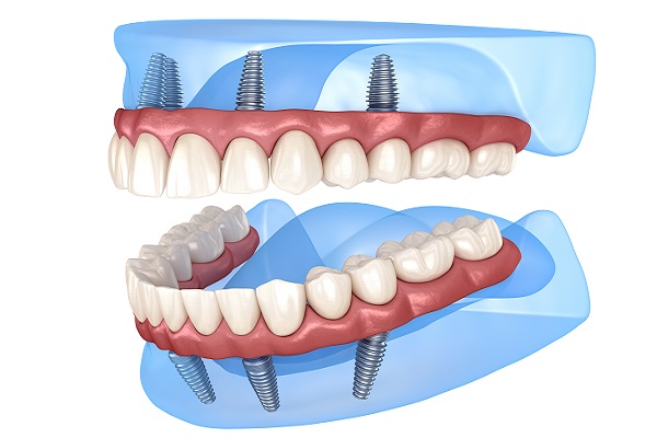 Implant Supported Dentures Carmel, IN