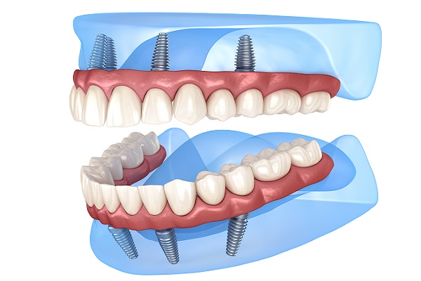 Differences Between Implant Supported Dentures And Traditional Dentures