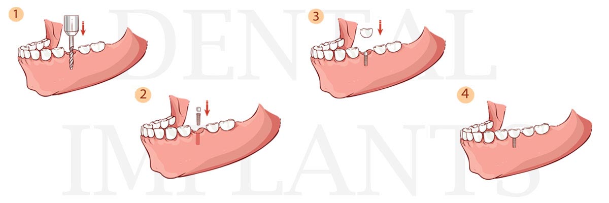 Carmel The Difference Between Dental Implants and Mini Dental Implants