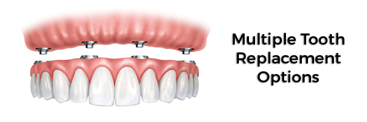 Carmel Multiple Teeth Replacement Options