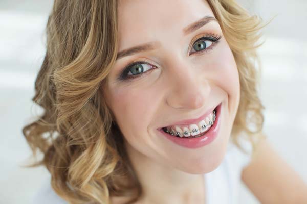 Teeth Whitening And Dental Braces