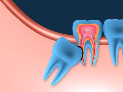 Wisdom Teeth 