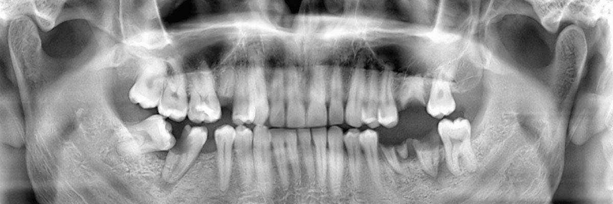 Carmel Wisdom Teeth Extraction